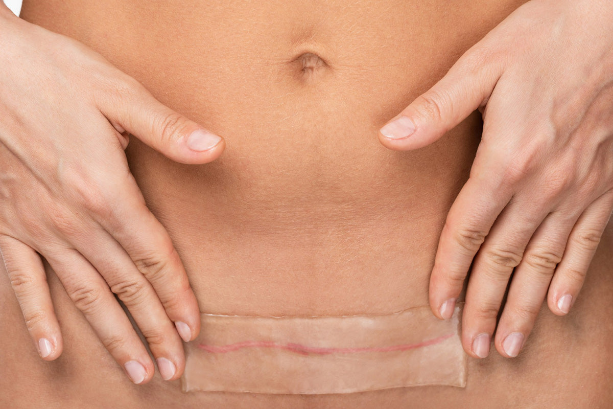 What Dermatologists & Surgeons Recommend for C-Section Scar Care