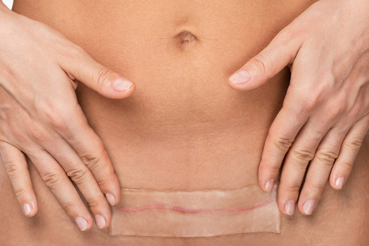 What Dermatologists & Surgeons Recommend for C-Section Scar Care