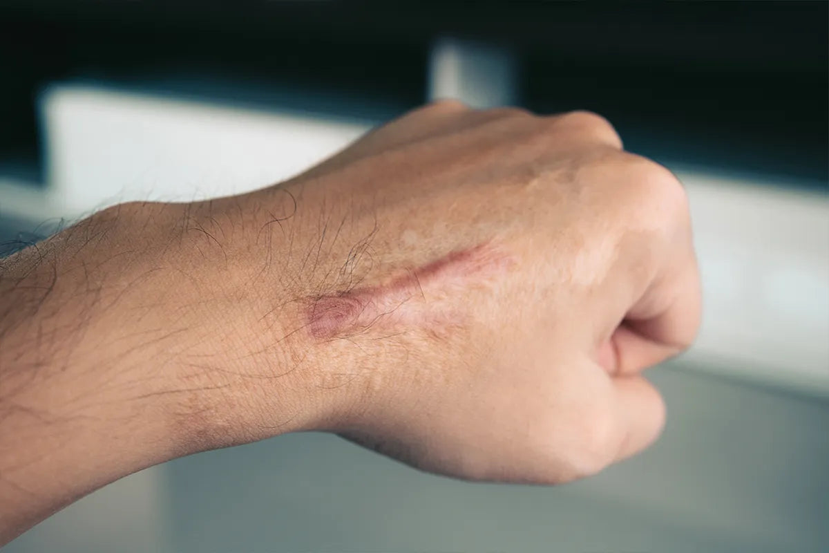 The 5 Types of Scars and Which Respond Best to Cream Treatment