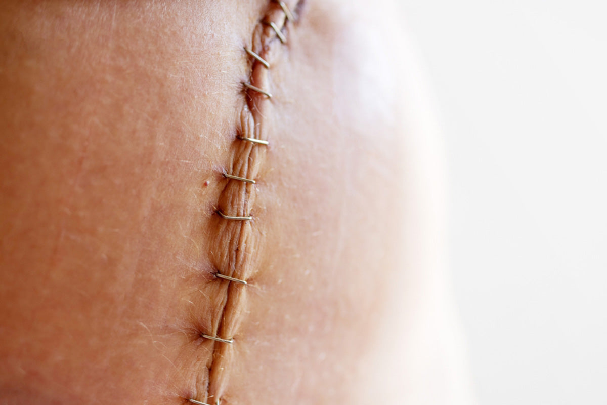 vertical vs bikini line hysterectomy scars treatment plans that work