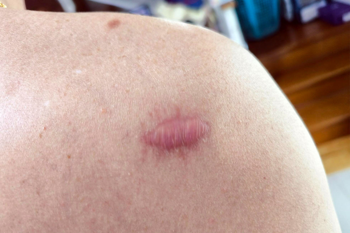 scar protocol hypertrophic vs keloid scars spot the difference treat early
