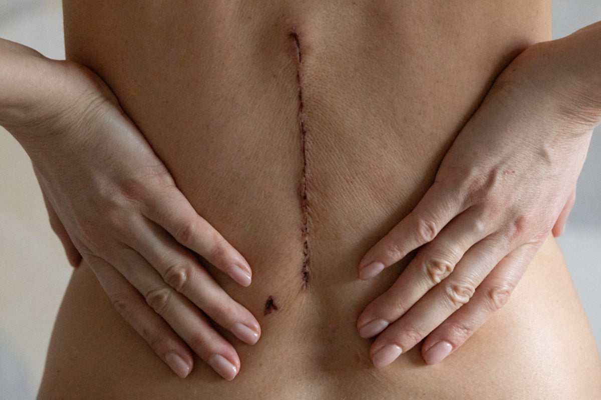 minimizing lumbar fusion scars tips for back incisions