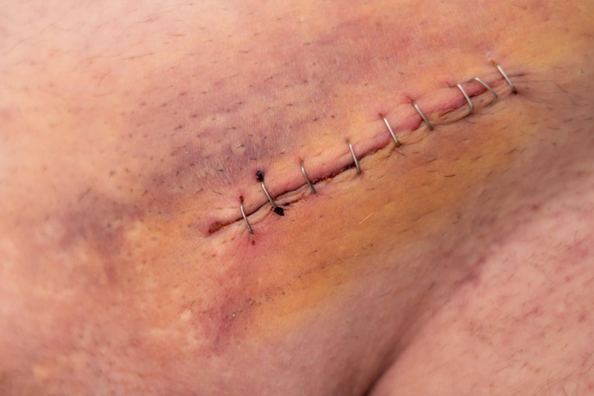 What Makes a Scar “Bad” vs. “Good”?