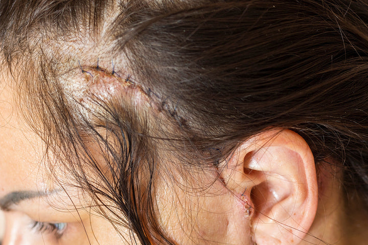 The 5 Phases of Scar Healing — Why Treatment Now Matters
