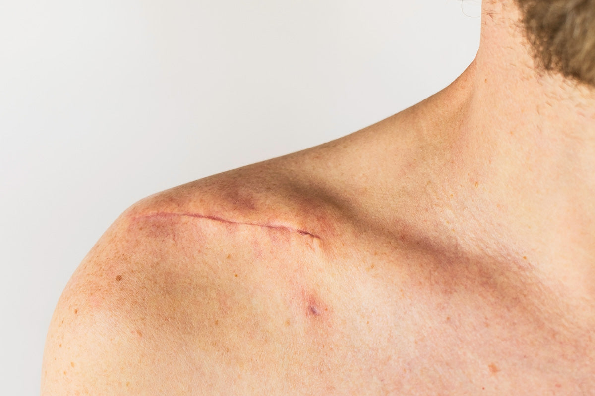 How Your Body Actually Heals a Surgical Scar: What to Expect Month by Month