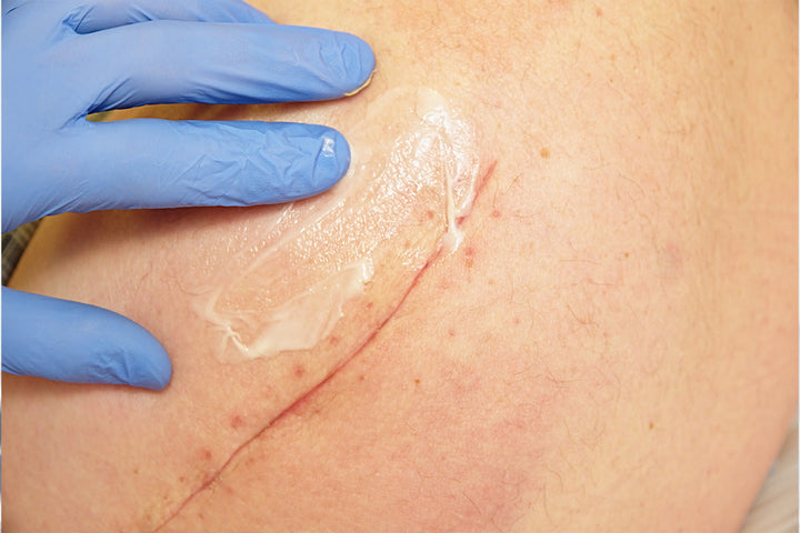 How to Apply Scar Cream Properly: Massage Techniques for Better Results