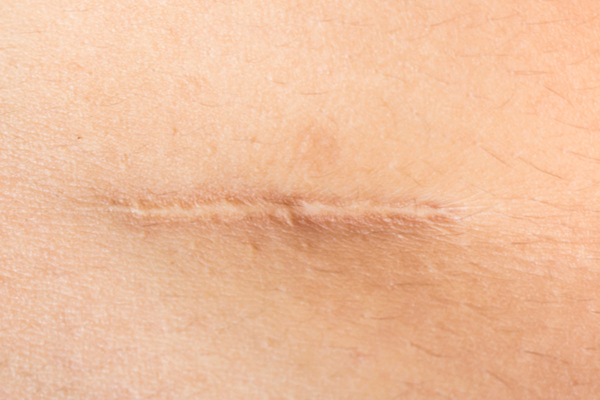 scar maturation phases explained from red to fade in 12 months
