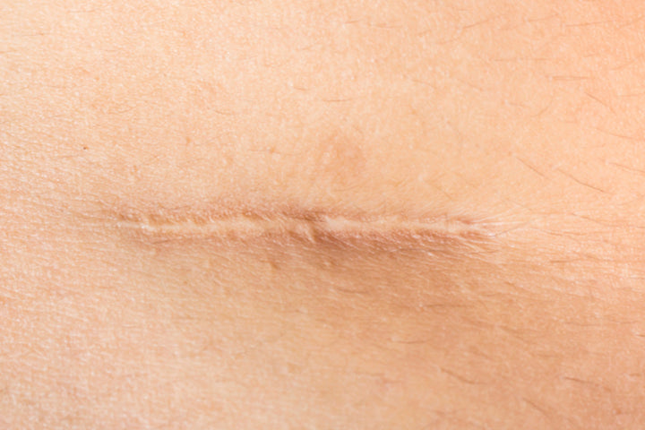 scar maturation phases explained from red to fade in 12 months