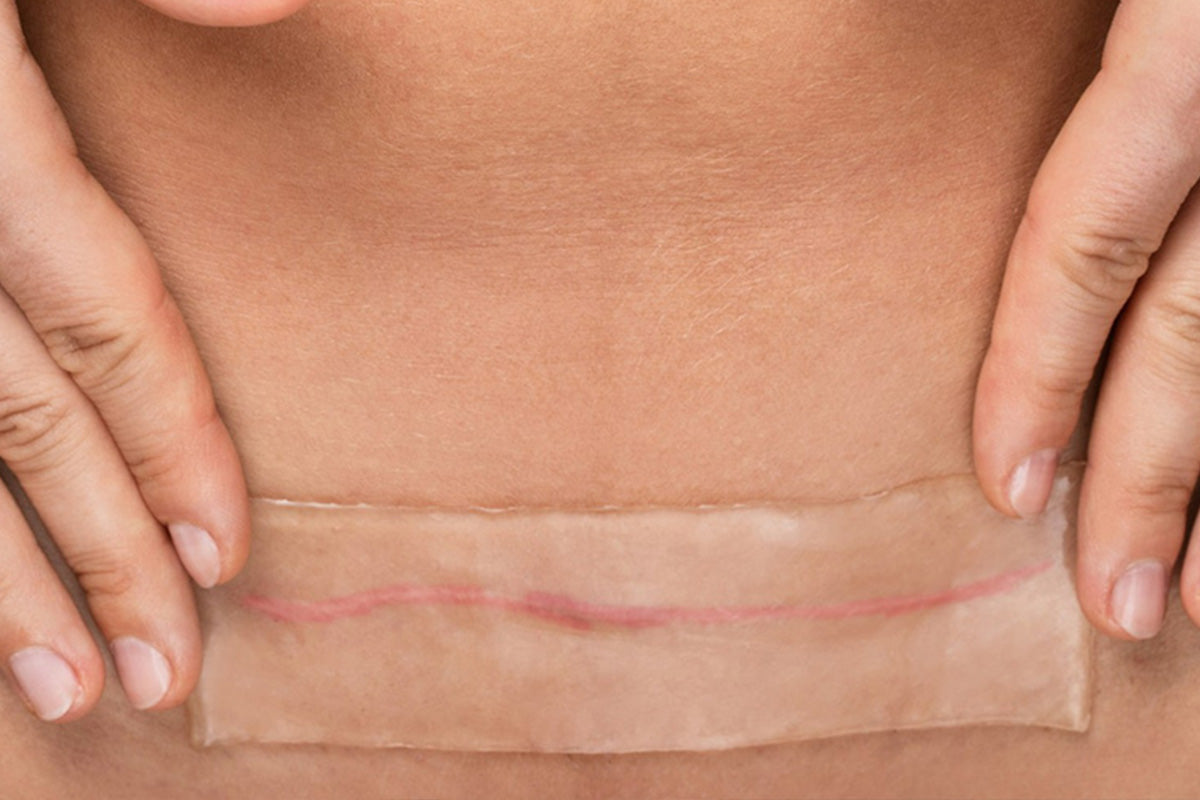 silicone sheets vs silicone creams which heals surgical scars faster