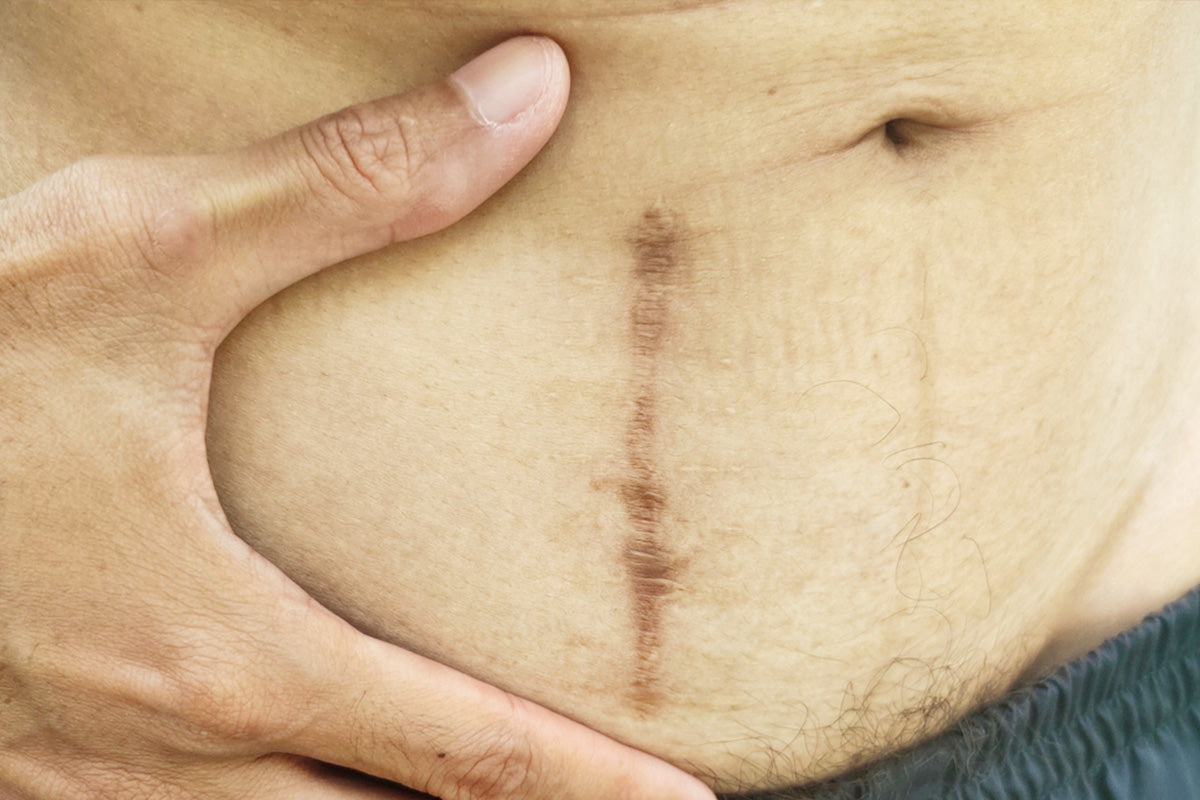can sunscreen prevent dark surgical scars dermatologists explain