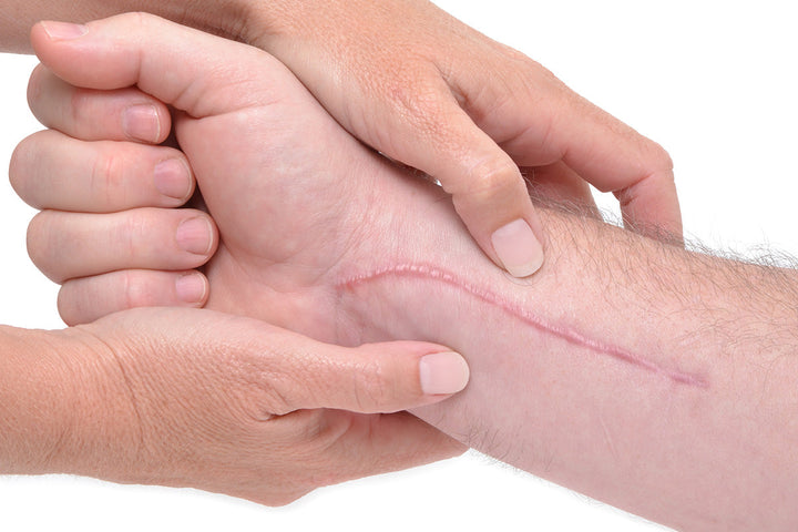 The Five Main Types of Scars and Which Ones Respond Best to Cream Treatment
