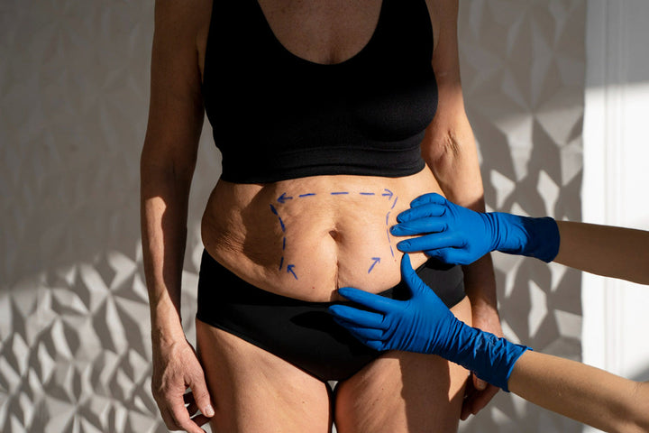 Body Lift (Post-Weight Loss Surgery) Scars Cream