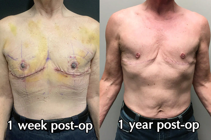 Gender-Affirming Surgeries Scars Cream