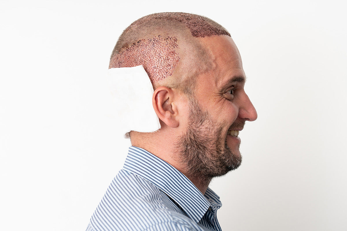 Hair‑Transplant Donor Area Scars: Minimizing Visibility in Short Haircuts
