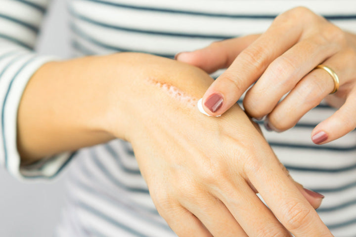 Hydration and Occlusion: How Moisturizing Improves Scar Appearance