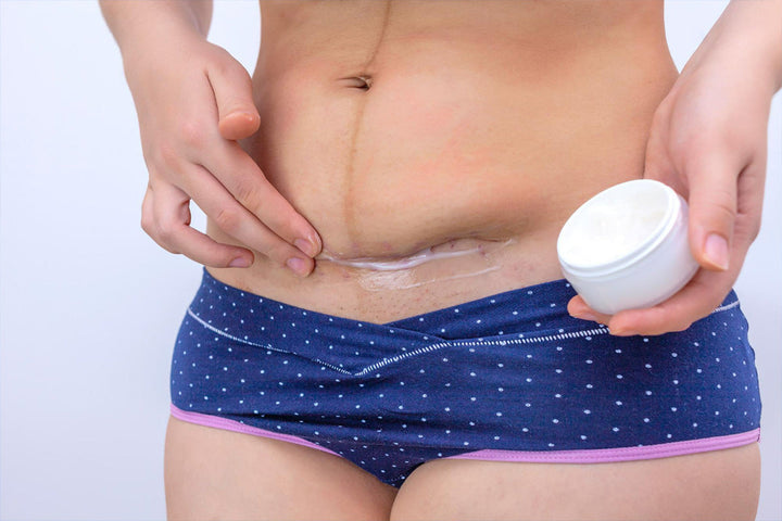 stretch mark creams vs surgical scar creams do you need two products
