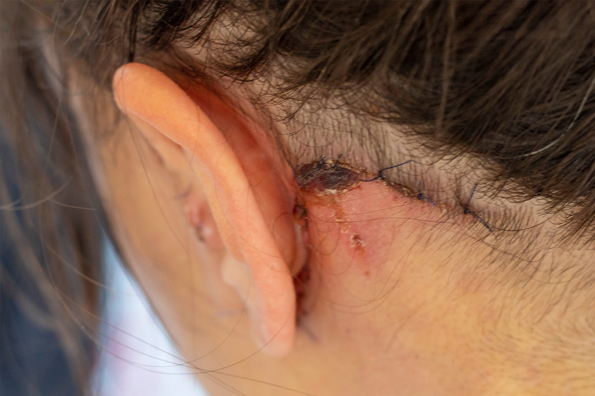 When Should You Start Scar Treatment? Pre-Op, Day 0, or 6 Months Later?