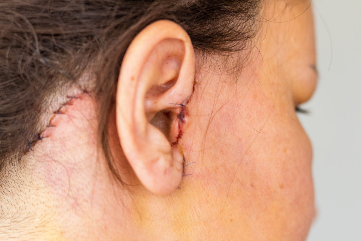 facelift scars along the hairline camouflage vs treatment