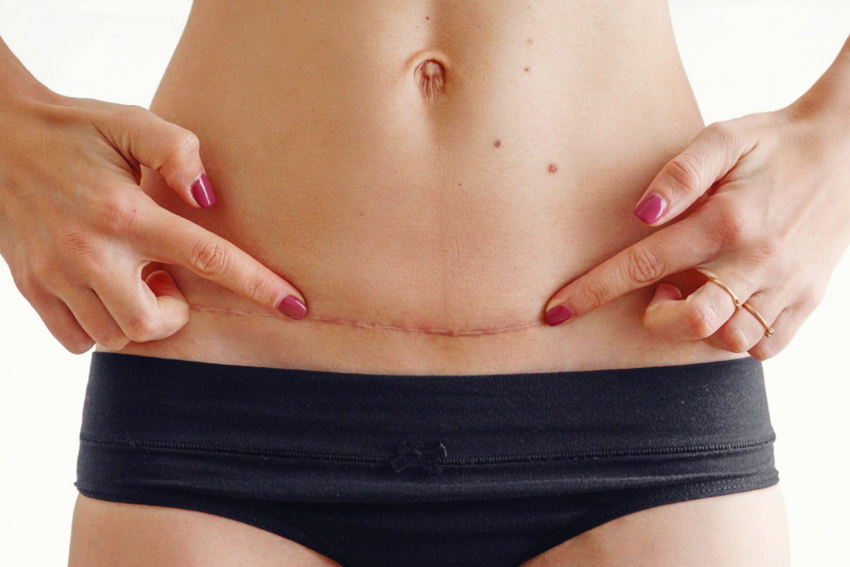abdominoplasty tummy tuck scar placement surgeon insights aftercare plan