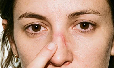 Recovery Stage Scars
