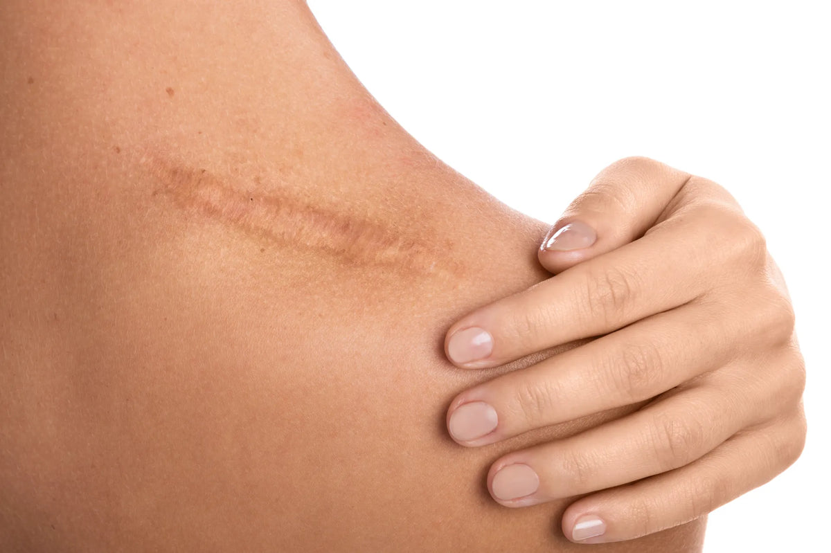 Existing Old Scar