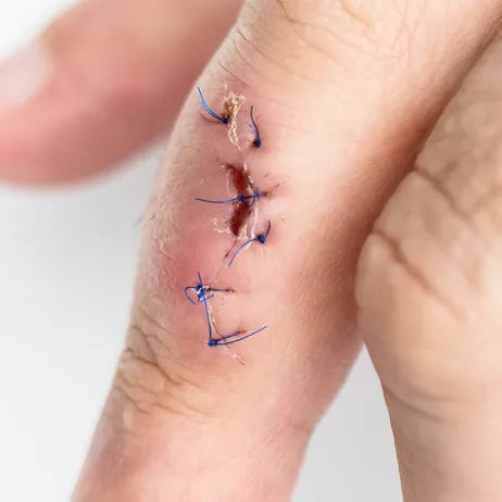 Cuts & Other Procedures