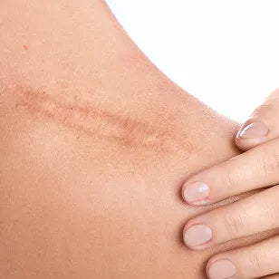 Keloids & Mature Scars
